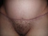 Hole in middle of incision??? WHY? Will this be fixed??