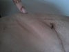 Left side above insicion, stiff mass under skin