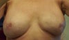 scar that is straight and does not round out with breast as I was told it would.