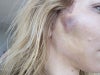 Early photo of hematoma on right cheek following mid-face lift and fat grafting.
