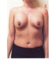 1st operation left breast hald deflated