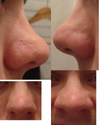 My nose