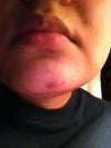 3 months after the facial hair reduction laser session, the scar and depression in chin still remains..