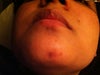 another close up of the burn scar
