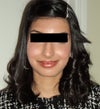 9 months after Hydroquinone/Hydrocortisone..Cheeks look heavily swollen.