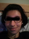 This photo was taken June 26, 2011. A year and a half after discontinuing Hydroquinone/Hydrocortisone. I am currently having bloodwork done because Doctor said the cream had no effect on my face even though my face change occured right after using the cream.