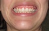 Asymmetric bite.