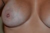 BREAST IMPLANT SCARS
