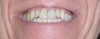Front teeth only