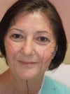 Just before surgery, May 13