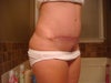 10 wk post op FTT