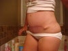 post op FTT