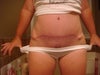 post op FTT