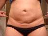 PRE OP photo of botched lipo