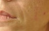 about 5-6 hrs after treatment