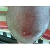 2 white pimples on my chin