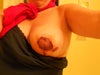 Left breast 5 days after surgery. No pain just ugly.