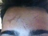 Scar on my forehead that I've had for as long as I can remember.