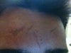 Scar on my forehead that I've had for as long as I can remember.