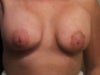 3 weeks post op RIGHT BREAST LOCATED ON RIGHT SIDE OF PHOTO