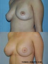 this is a moderate droop with implants that i think look good in fact natural.