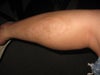 scar from left leg