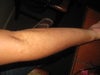 scar from left arm