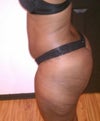 1 mth pre-op
