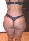 1 mth pre-op