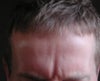 This is me trying to frown.. Surely after botox I shouldnt be able to frown as I did before like this?