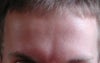 This is when I am trying to raise my eyebrows, there is not much movement upwards now, but a lot of movement downwards still.