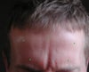 This is my opinion, The RED dots are where I think I need the botox to fix my frown area! and the GREEN dots are where she had just injected me for the 3rd time as she said the out side one will give me more lift! and the frown area is already frozen so she said it doesnt need anymore in there?? so she didnt treat where I have marked the red dots!  PLEASE tell me do I need to go back for a 4th time and have where I have marked the Red dots please?