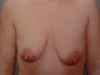 Before lift & implants