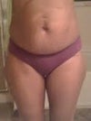 I have partial hysterectomy & c-section scars!
