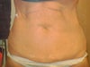 pre op - before