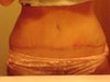 3.5 weeks post op
