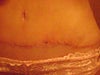 3.5 weeks post op smalll dark spot silver nitrated today