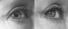 Outer corner of eye, taken a day apart. Sometimes the eye looks more rounded, other times the vertical scars are more noticeable.