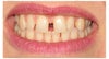 Gaps in top front teeth.