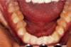 lower teeth