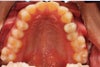 upper teeth