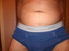 This is how it looks 2.5 yrs after my procedure.  May be tough to see, but the right side has more "fat" than the left side.