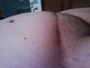 Pink scar and swelling, almost a year post-op.
