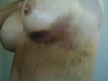Bruising: Some bruising started immediately post op.  Some started 10 days post op.This photo is 10 days post op.