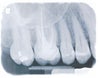 Tooth #3 with broken file touching sinus....