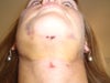 Lesion on neck