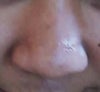 This is how it looks like. I hate it so much . Please what are the ossible treatment for these?