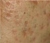 acne scar