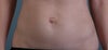 Before the surgery.