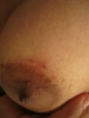 You can see the blue string hanging from the stitch.
My doc tried to pull it but it doesn't go out.